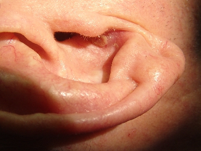 This elderly patient was noticed to have a basal cell carcinoma of the concha, just behind the tragus.