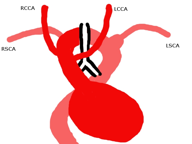 A CT chest was performed in the arterial phase. A diagram of the findings is seen. The left common carotid artery arose from the ascending aorta. The aortic arch was to the right of the trachea, and passed posterior to it. The right common carotid and right subclavian arteries arose from the arch in that order. From the posterior arch, the left subclavian artery arose from a large diverticulum (this corresponds to the left “aortic knuckle” seen on the PA film). The descending aorta then crossed to the right again before passing through the diaphragm in the midline. This appearance may be due to right aortic arch with aberrent left subclavian artery, or to double aortic arch with atresia of the left arch, subtype 3. This case is more likely to be the former, as there was no narrowing of the trachea, and subtype 3 double aortic arch is rare. The anatomic difference between these two anomalies is persistence or not of an atretic segment of the left arch.