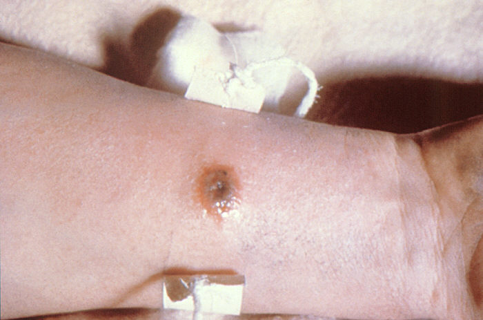 "Anthrax lesion on volar surface of right forearm”Adapted from Public Health Image Library (PHIL), Centers for Disease Control and Prevention.[20]
