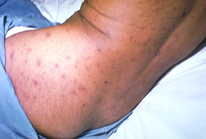Chickenpox lesions on the skin of this patient's back and buttocks at day 6 of the illness. From Public Health Image Library (PHIL). [27]
