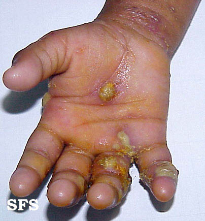 url = http://www.atlasdermatologico.com.br/disease.jsf?diseaseId=416>