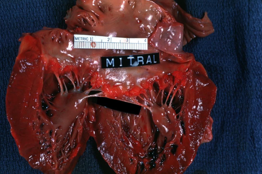 Thrombotic Nonbacterial Endocarditis: (Gross) Mitral valve, an excellent example