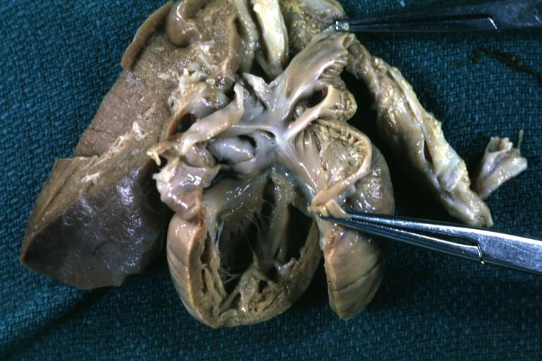 Cor Triatriatum: Gross fixed tissue opened infant heart with the two chambered left atrium