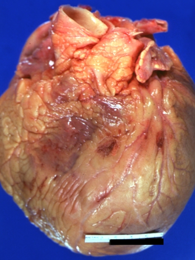 Heart: Gross, Natural Color, Acute Chagas Disease