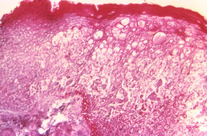 Hematoxylin and eosin (H&E)-stained tissue sample, reveals some of the histopathologic changes found in a human skin tissue sample from the site of a smallpox lesion. Adapted from Public Health Image Library (PHIL), Centers for Disease Control and Prevention.[14]