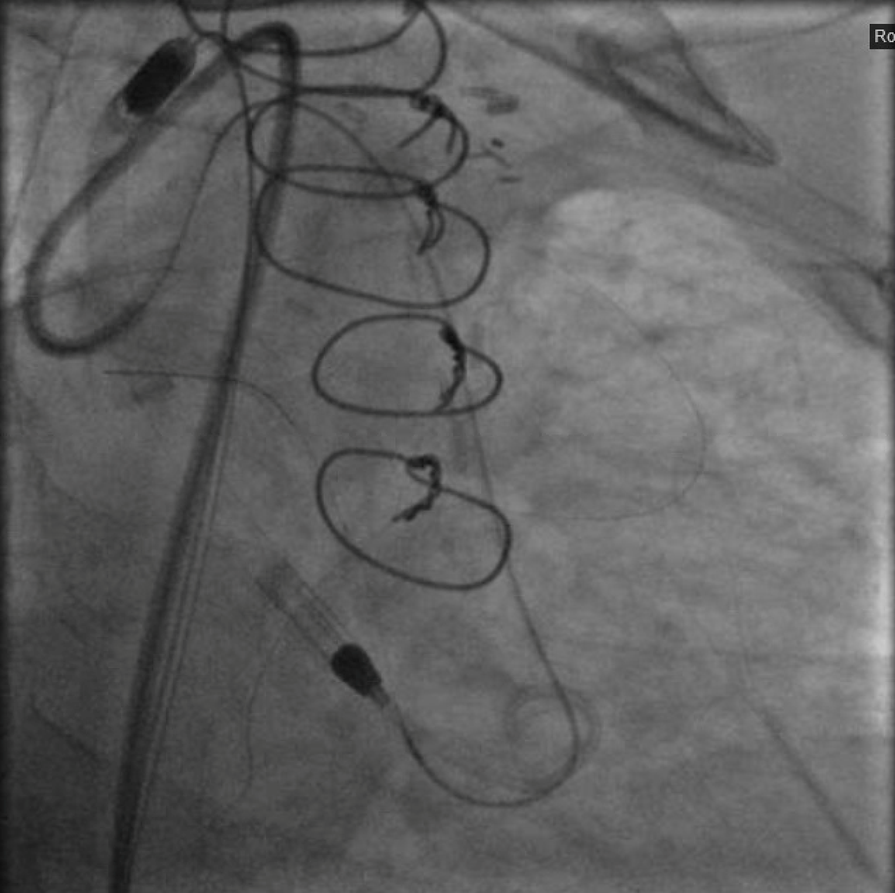 Figure 3. Crossing the left main CTO from the retrograde approach with a Pilot 200 wire supported by a Corsair microcatheter (currently being withdrawn).