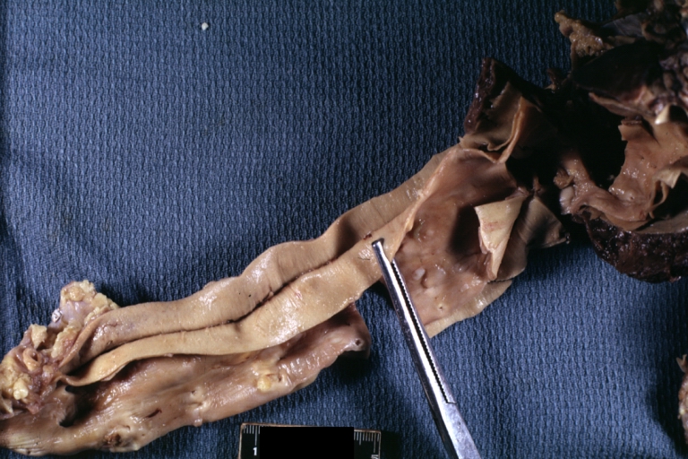Dissecting Aneurysm: Gross, fixed tissue, descending thoracic segment dissection opened to show the false channel. The true surface is also visible