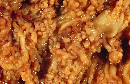 Colonic pseudopolyps of a patient with intractable ulcerative colitis. Colectomy specimen.