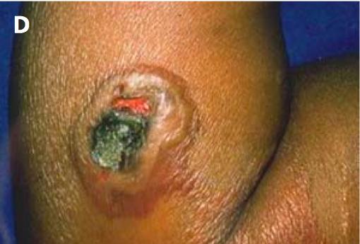 Day 6 of development and resolution of uncomplicated cutaneous anthrax lesion.”Adapted from World Health Organization (WHO)[1]
