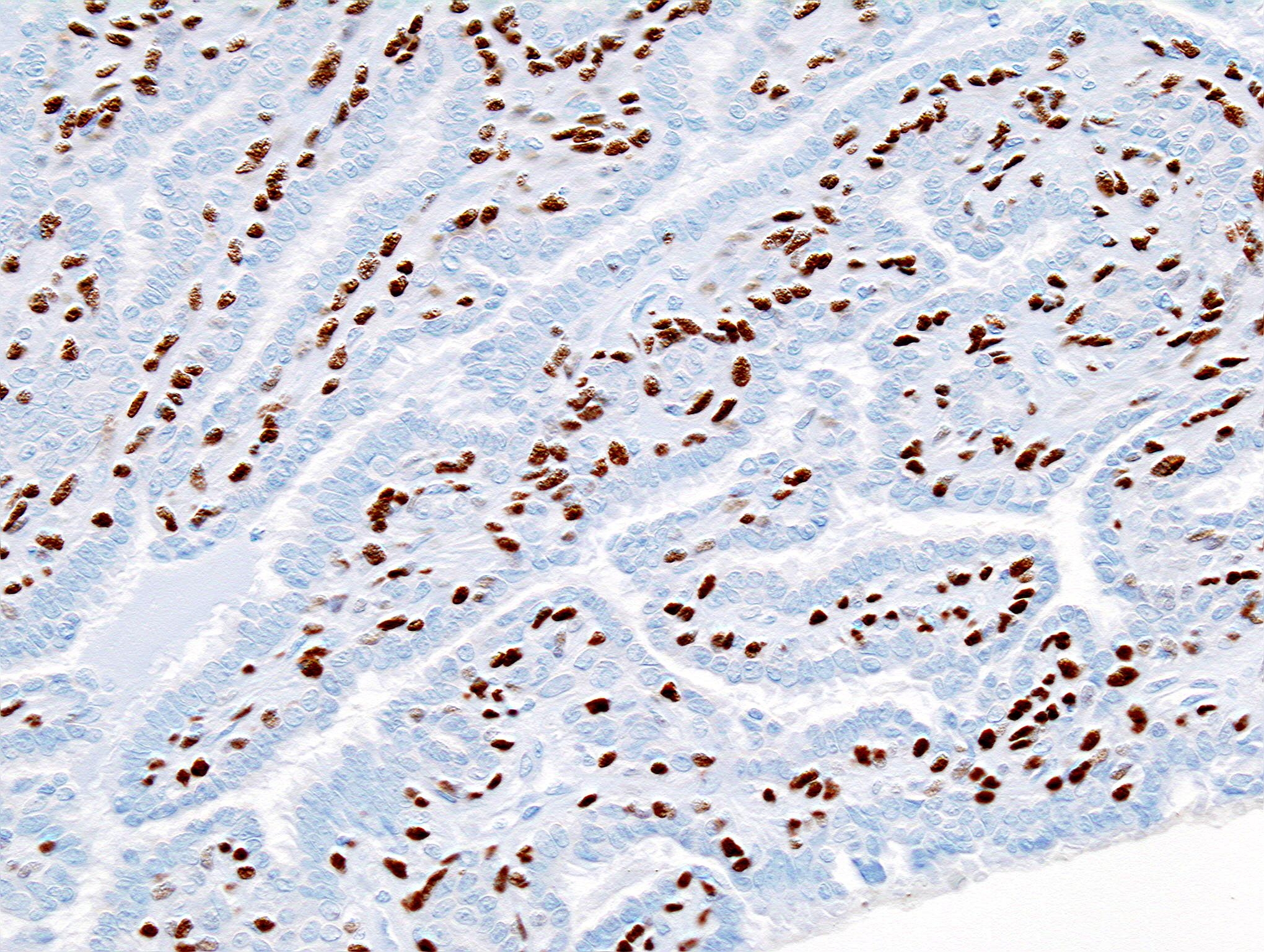 Histopathology of intraductal papilloma of the breast by excisional biopsy. Immunostaining for p63 protein.