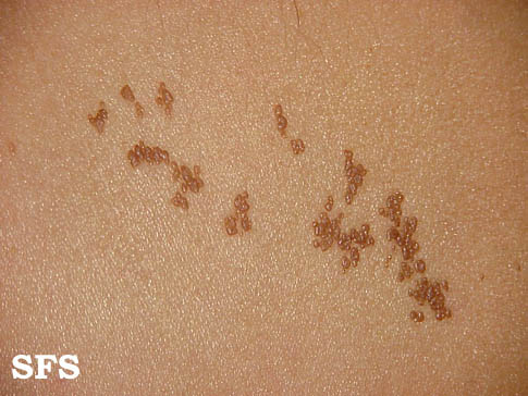 Naevus epidermal. Adapted from Dermatology Atlas.[3]