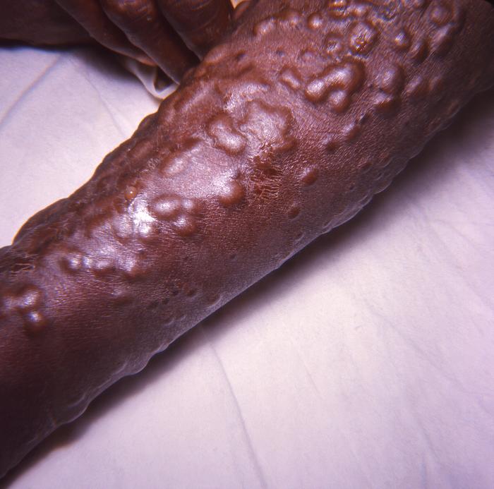 Child’s arm, which displays the characteristic maculopapular rash due to the smallpox virus.Adapted from Public Health Image Library (PHIL), Centers for Disease Control and Prevention.[3]