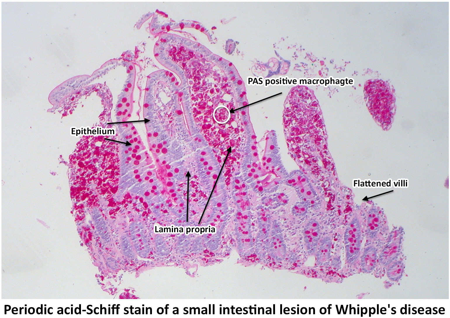 File:Whipple disease PAS stain 1.jpg