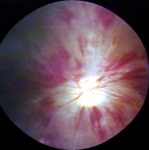 Fundoscopy: Central retinal vein thrombosis