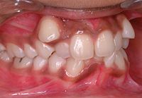 Class I with severe crowding and labially erupted canines