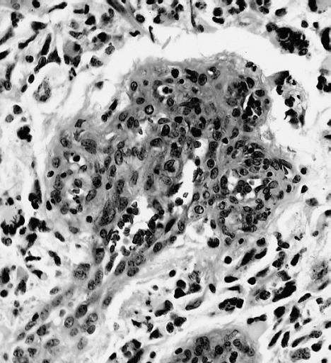 CNS: Glioblastoma multiforme; At high magnification, the neovascular tuft is a mass which, as can be confirmed by immunohistochemistry, is formed of both endothelial cells and smooth muscle cells (pericytes).