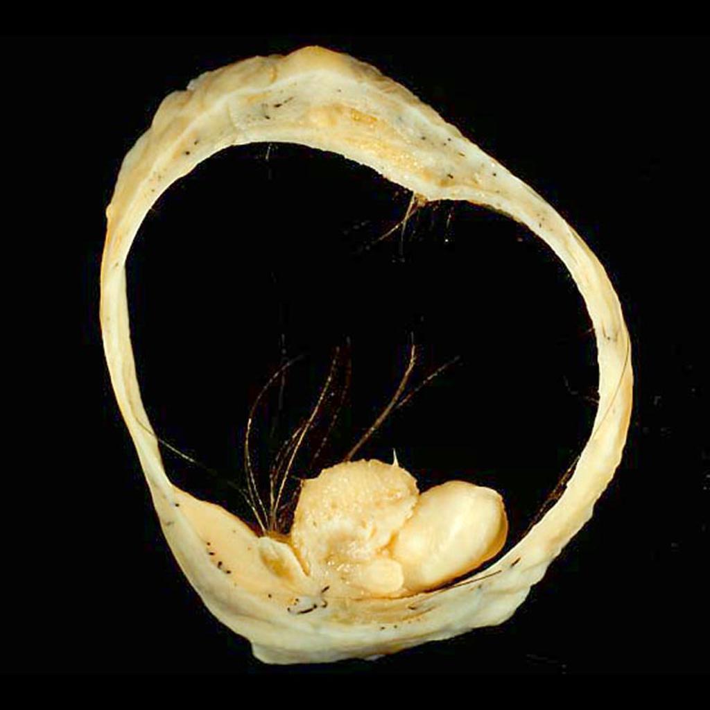 Mature cystic teratoma of the ovary.[7]