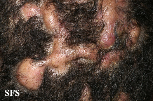 Perifolliculitis capitis. With permission from Dermatology Atlas.[4]