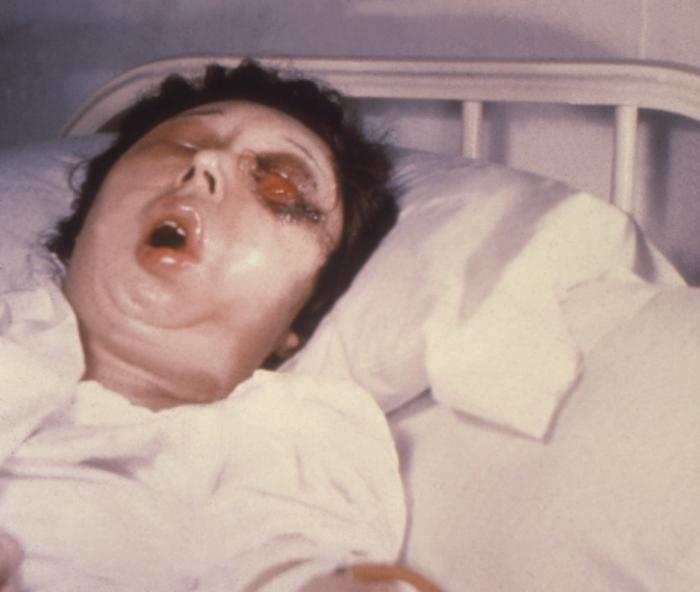 Female patient shown here on the 5th day of a Bacillus anthracis infection involving her left eye.” Adapted from Public Health Image Library (PHIL), Centers for Disease Control and Prevention.[3]
