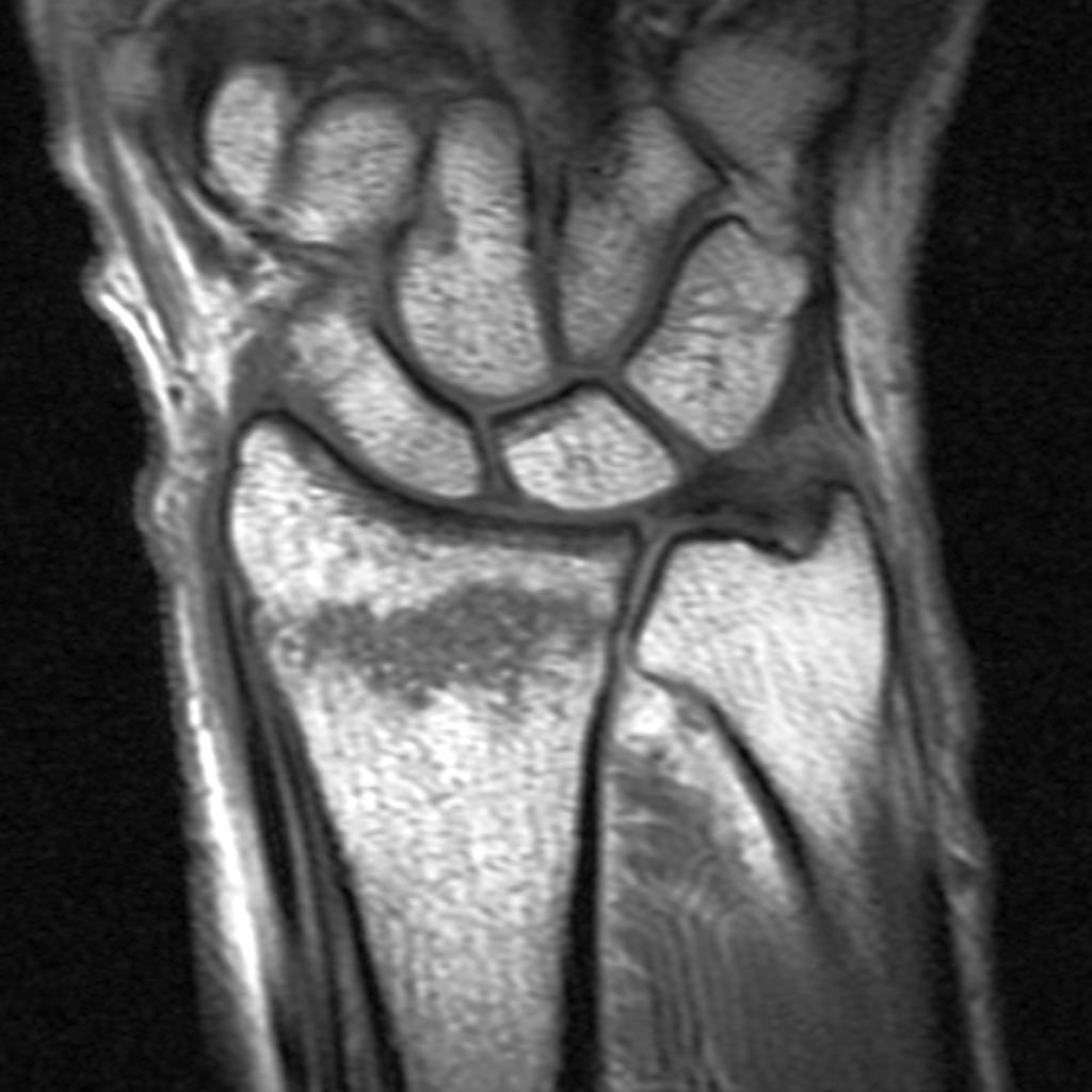 File:MRI- non-displaced-distal-radial-fracture-.jpg