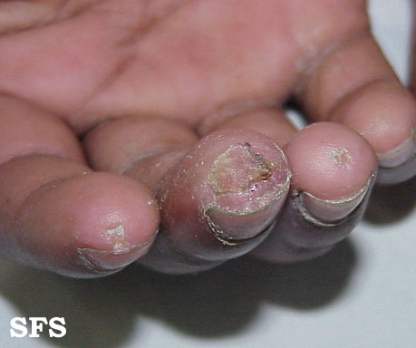 File:Mixed connective tissue disease 02.jpg