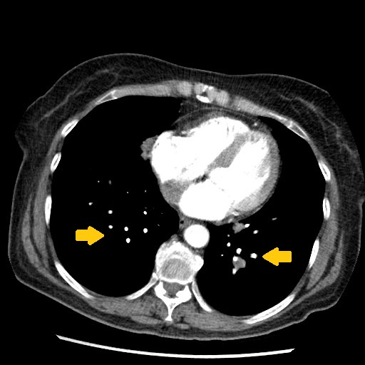 File:Amyloidosis-bronchial-and-diffuse-nodular-pulmonary-involvement.jpg