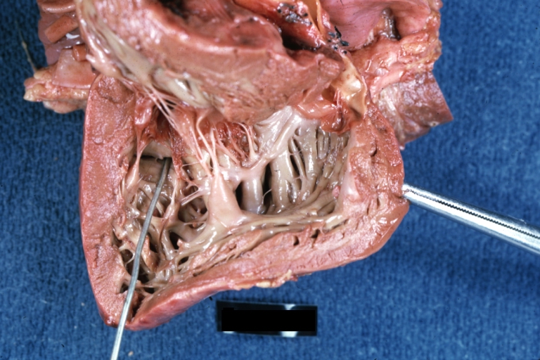 Interventricular Septal Defect: Gross, fixed tissue, opened right ventricular outflow tract positioned to show perimembranous septal defect (as surgeon would see it during repair)