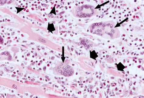 Multinucleated giant cells (long arrows) are seen adjacent to degenerating myocytes (short arrows). The cellular infiltrate contains lymphocytes, histiocytes, and collections of eosinophils (arrowheads) (hematoxylin and eosin, x400)