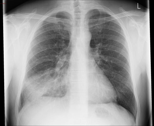 File:Pneumonic infiltration of the right middle lobe.jpg