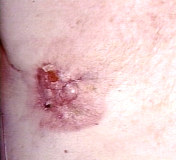 Breast carcinoma, 55 y o male; ulceration of skin even though a small tumor (a rare case)