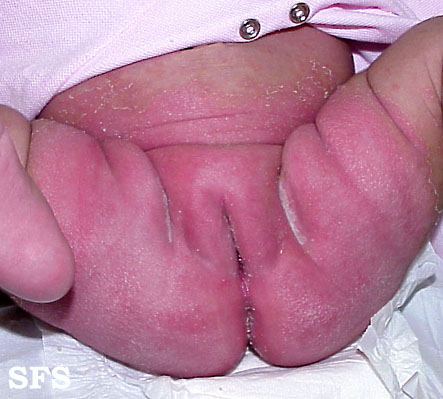 Diaper dermatitis. Adapted from Dermatology Atlas.[13]