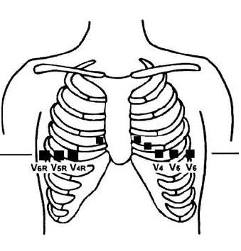 Places of chest leads during EKG recording for suspected RVMI.