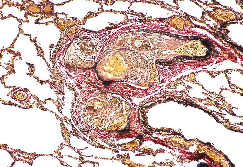 The appearance suggests multiple lesions but a single lesion cannot be excluded. Note the destruction of the arterial wall at the site of the angiomatoid lesion. Destructive arterial changes are frequently associated with angiomatoid lesions. There is an elastic stain.
