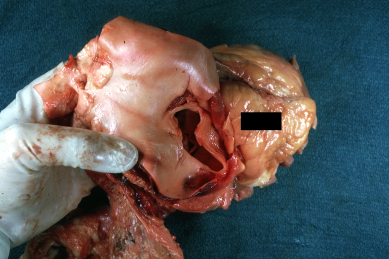Dissecting Aneurysm: Gross, large tear in first portion of aortic arch, annuloaortic ectasis
