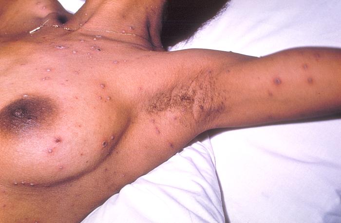 Chickenpox lesions on the skin of this patient's left breast and arm on day 6 of the illness. From Public Health Image Library (PHIL). [24]