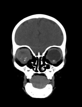 File:Coronal non contrast retinoblastoma.jpg