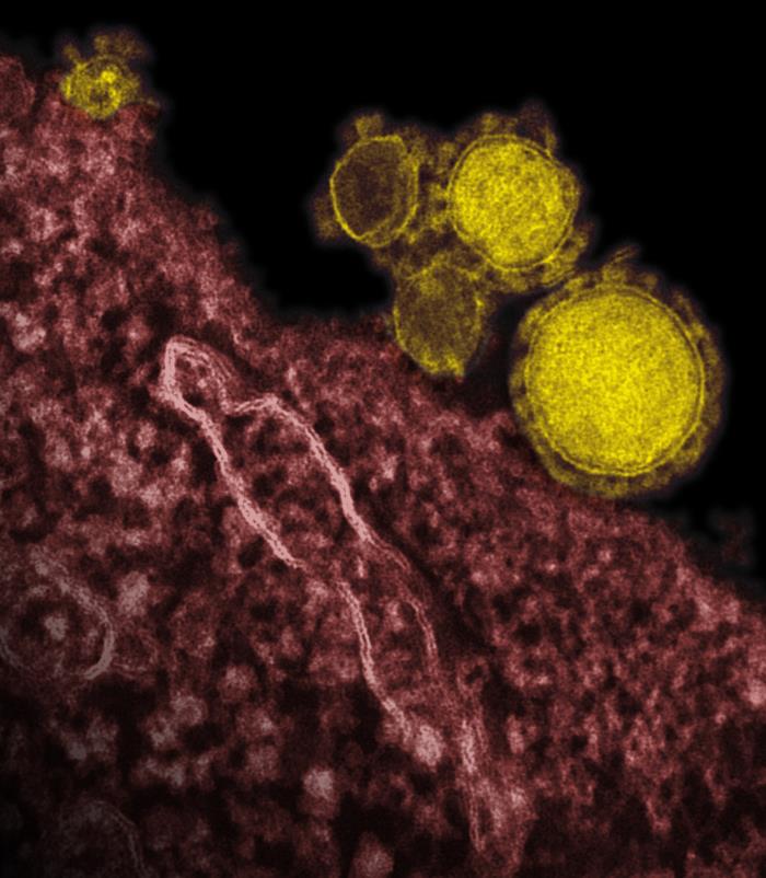 TEM reveals ultrastructural details exhibited by five spherical-shaped Middle East Respiratory Syndrome Coronavirus (MERS-CoV) virions, which were colorized yellow. From Public Health Image Library (PHIL). [1]