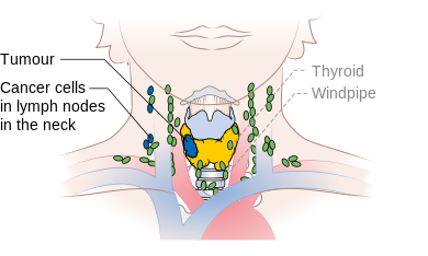 Stage N1b thyroid cancer