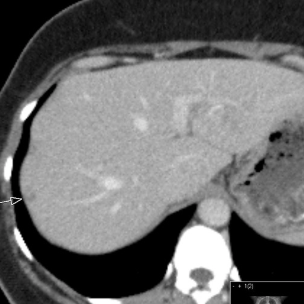 Bright dot sign: Bright dot within a lesion which remains hyper-attenuating on arterial and portal venous phase CT, corresponding to early nodular enhancement seen on liver hemangioma