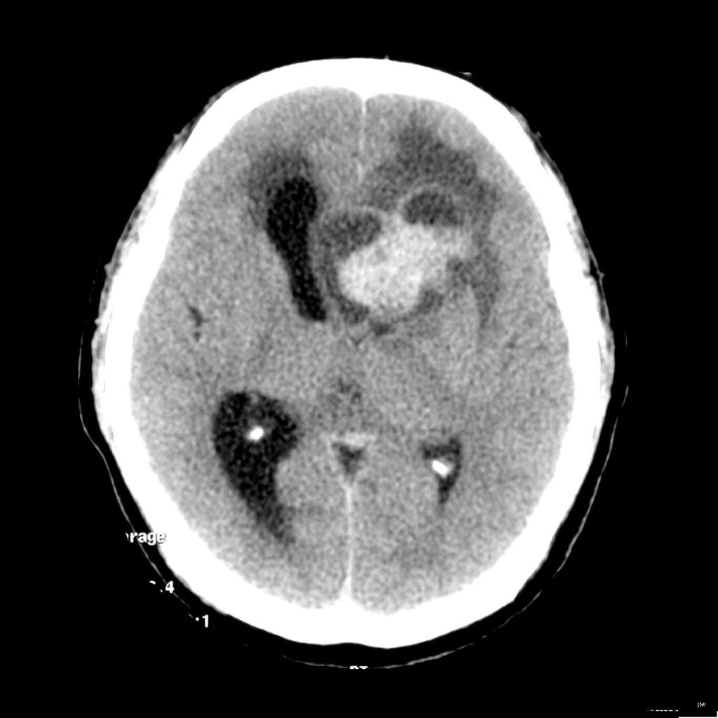 A large, heterogeneous mass is present within the left frontal lobe. It is strikingly hyperdense, without definite calcification. The solid component enhances. Hydrocephalus is present, best seen on the right, due to outflow obstruction (noncontrast CT)[2]