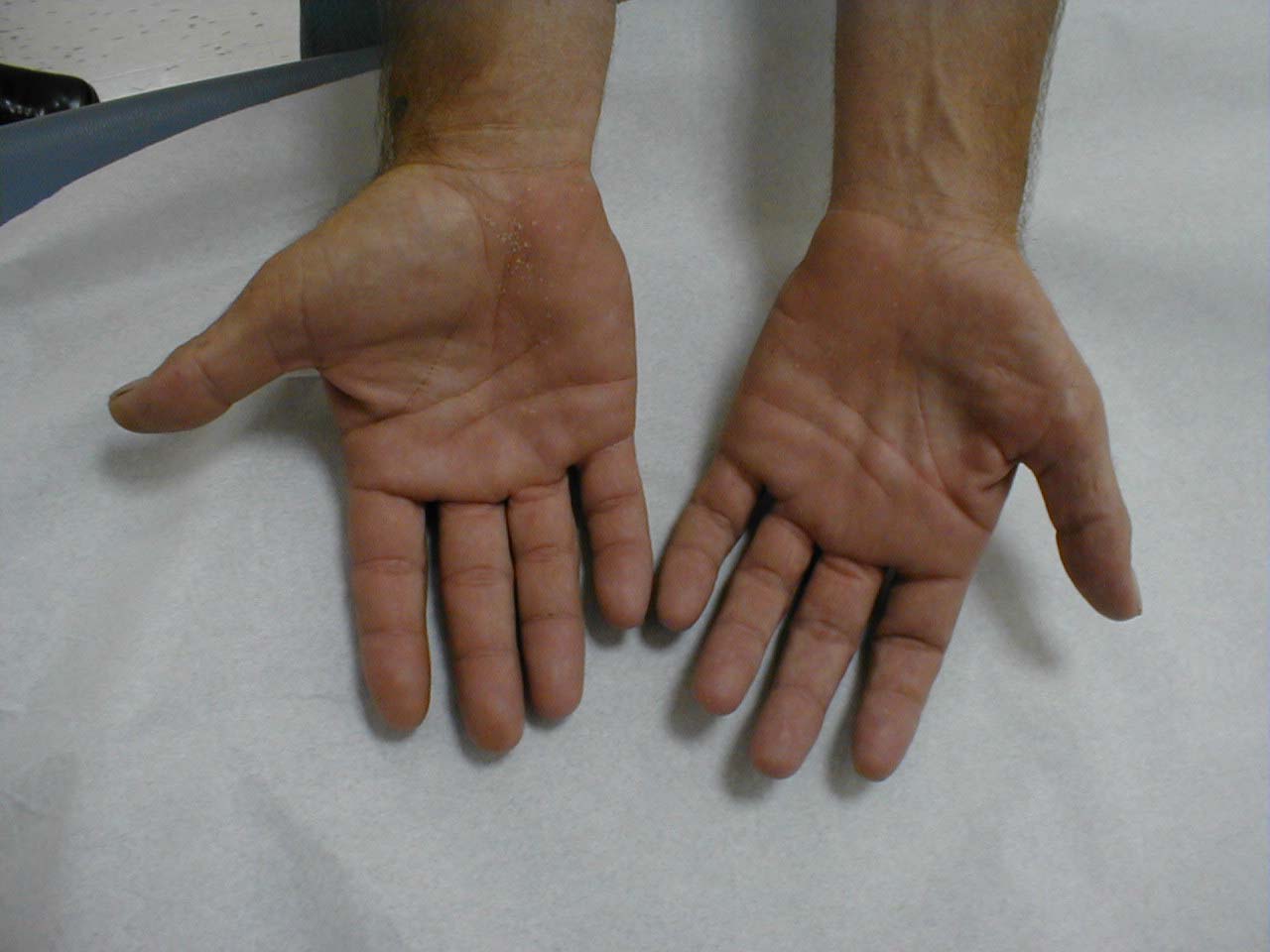 Muscle Wasting Left Hand: Atrophic flattening most prominently seen in the thenar and hypothenar muscles, resulting from generalized denervation.