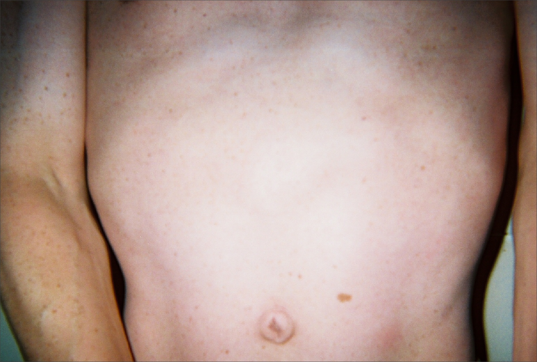 Torso of thirty seven year old, second generation patient, exhibiting lentiginosis.