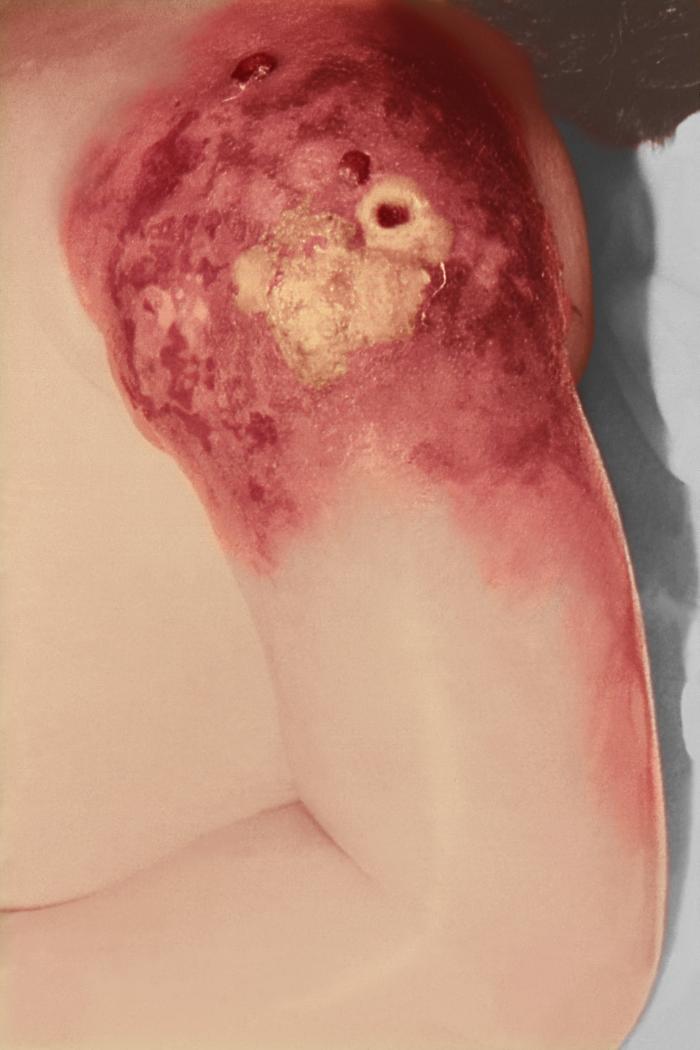 7 year-old male patient with microcephaly, and cerebral palsy, subsequently developed progressive vaccinia after having received a smallpox vaccination in his left shoulder. Note the large necrotic area at the vaccination site. Adapted from Public Health Image Library (PHIL), Centers for Disease Control and Prevention.[3]