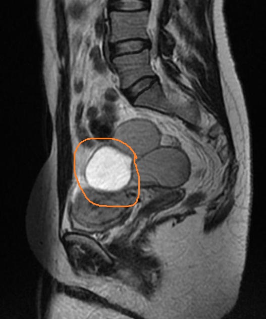MRI showing endometriosis of uterosacral ligament.