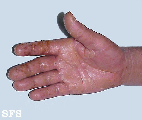 Contact dermatitis. Adapted from Dermatology Atlas.[1]