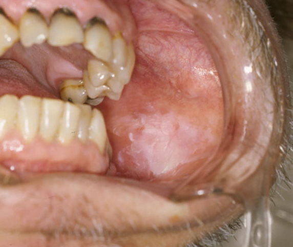 The white lesion is an example of leukoplakia.
