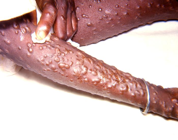 Right arm, right thigh, and left hand of an adult, displaying the characteristic maculopapular rash due to the smallpox virus.Adapted from Public Health Image Library (PHIL), Centers for Disease Control and Prevention.[3]