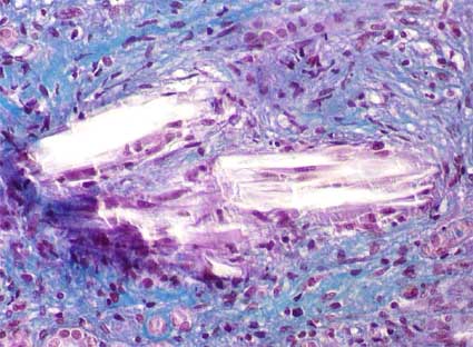 Medullary interstitial urate crystal deposits in chronic nephropathy by urates as seen after Masson's trichome stain X400[10]