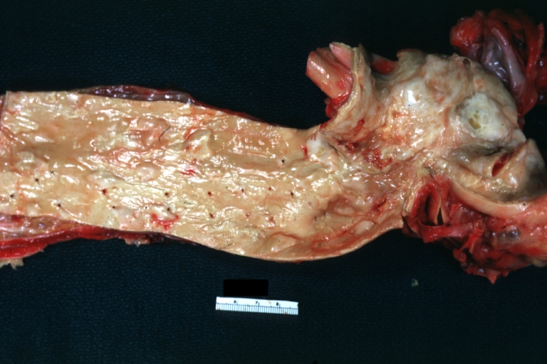 Atherosclerosis: Aorta: Gross, good example of fibrous plaques