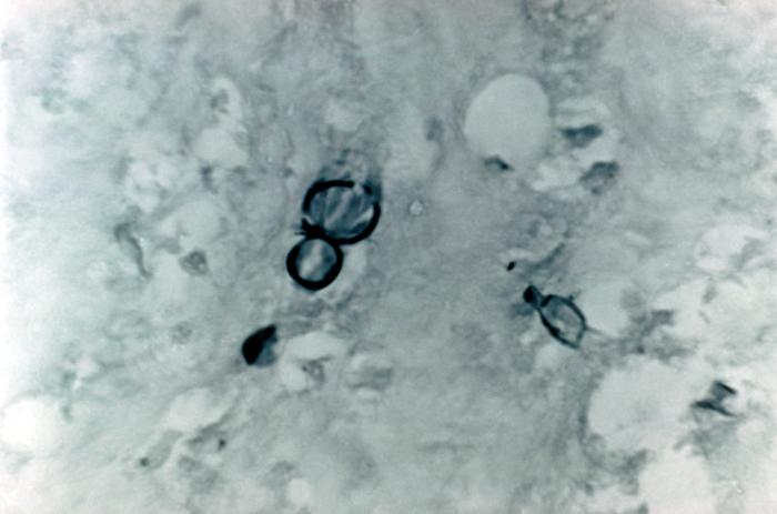 Note the histopathologic changes seen in blastomycosis due to Blastomyces dermatitidis using methenamine silver stain. From Public Health Image Library (PHIL). [3]